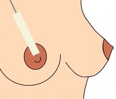 Zufütterung an der Brust mit der Sonde