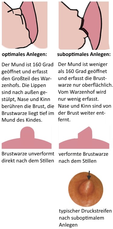 Grafik zur Entstehung wunder Brustwarzen