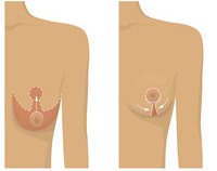 Schema einer Brustverkleinerung