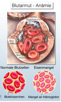 Grafik mit roten Blutkörperchen: gesunde und verkleinerte, blaße Blutkörperchen