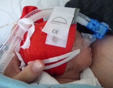 Foto über frühgeborenes Baby an der Brust