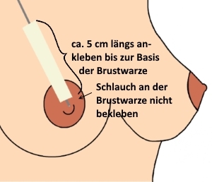 Grafik, in der das Ankleben des Schlauchs des Brusternährungssets gezeigt wird.