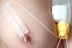 Stillen mit dem Brusternährungsset: ein Schlauch führt aus einem Milchbehälter Milch zur Brustwarze