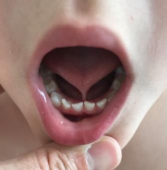 Zungenband bei einem Kind: Die Zungenspitze ist mit einem Band hinter den Zähnen am Mundboden festgehalten.