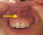 Sichtbares Lippenband einer Erwachsenen, die das obere Zahnfleisch mit der hochgeschobenen Oberlippe verbindet.