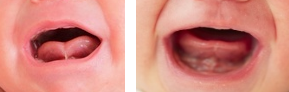 Zwei Fotos von schreienden Babys nebeneinander: links ein Baby mit auffälligem Zungenband, das die Zungenspitze mit dem Mundboden verbindet und herzförmig geformt ist. Rechts ein Baby mit runder Zungenspitze ohne sichtbares Zungenband