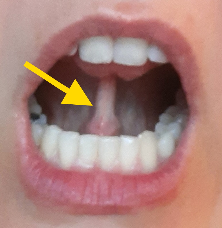 Zungenband einer Erwachsenen: Die Zunge ist hochgehoben, darunter ist ein Band zu sehen.