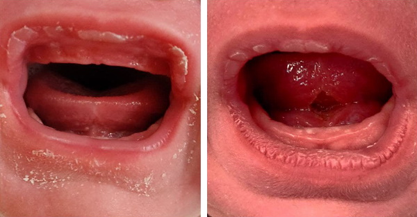 Zwei Fotos nebeneinander: links Zunge eines Babys vor einer Frenotomie, rechts Zunge des Babys nach der Frenotomie. Rechts ist eine rautenförmige Wunde unter der Zunge sichtbar.
