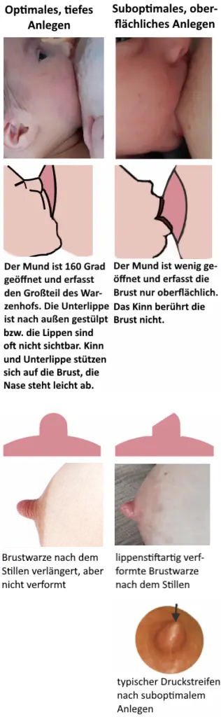 Vergleich eines tiefen, optimalen mit einem oberflächlichen Anlegen und der Verformung der Brustwarze als Grafik und als Foto als Risikofaktor einer wunden Brustwarze