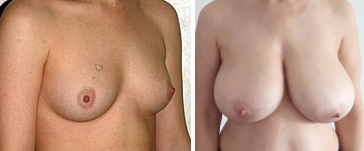 Zwei Frauen, einmal mit sehr kleinen, einmal mit sehr großen Brüsten