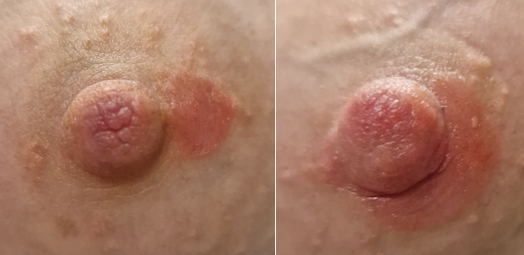 Psoriasis in der Stillzeit: rote Ausschläge auf dem Brustwarzenhof