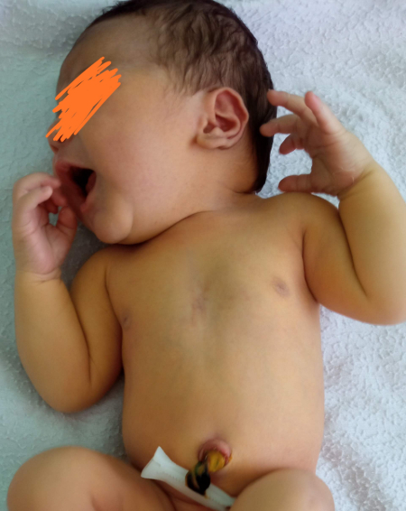 Baby mit Gelbsucht